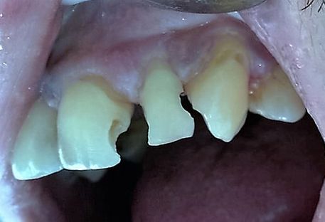 Clínica Dental Catoira Dra. Lorena Busto dientes gastados