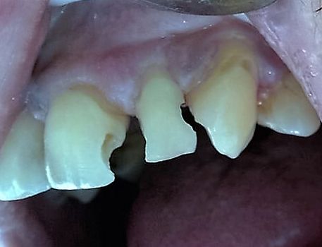 Clínica Dental Catoira Dra. Lorena Busto dientes gastados